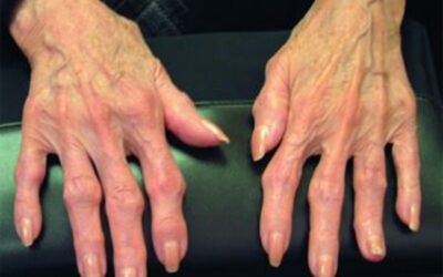 Остеоартрит            